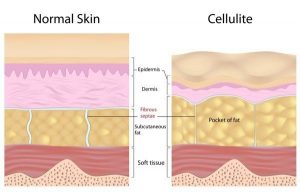 Normal Skin vs Cellulite